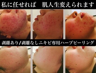 肌質改善専門店×ハーブピーリング Snow skin | 千葉のエステサロン