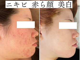 肌質改善サロンNoa | 新宿のエステサロン 肌質改善サロンNoa | 新宿のエステサロン