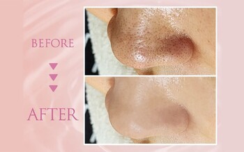 韓国肌管理専門店 Clear Lab 上野【ララピール公認/毛穴洗浄/ハイドラ/ピーリング】 | 上野のエステサロン