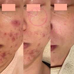 肌質改善水玉リフティング＆ハーブピーリングsalonvary | 恵比寿のエステサロン