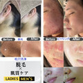 【ハーブピーリング|肌質改善】BE:SKIN広島 | 袋町/本通/紙屋町/立町のエステサロン