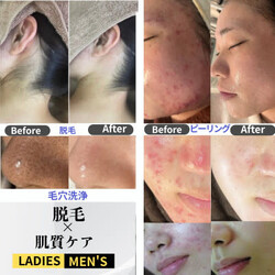 【ハーブピーリング|肌質改善】BE:SKIN広島 | 袋町/本通/紙屋町/立町のエステサロン