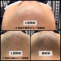 メンズ脱毛ビーグラッド大阪南森町 | 天満/南森町のエステサロン メンズ脱毛ビーグラッド大阪南森町 | 天満/南森町のエステサロン