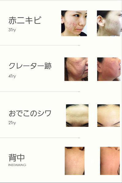 ハーブピーリング専門　Lebelle:(リベル)名古屋 | 栄/矢場町のエステサロン