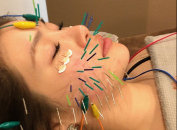 アキュリード(美容鍼灸エステサロン) | 元町のエステサロン