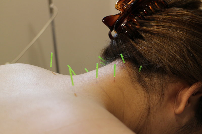 アキュリード(美容鍼灸エステサロン) | 元町のエステサロン