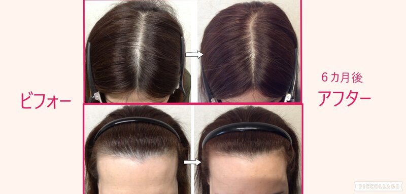 [アイキャッチ]結果が見える毛密エステ✨MOUMITU スカルプトリートメント✨