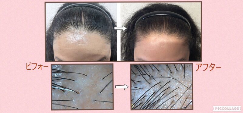 [アイキャッチ]薄毛改善・毛密エステ≪MOUMITU≫