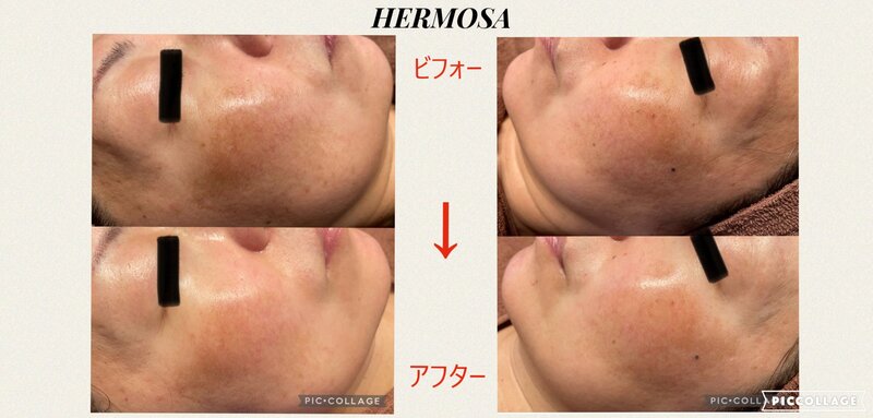 [アイキャッチ]★エルモサ・ブラックハーブトリートメント★ BFORE～AFTER