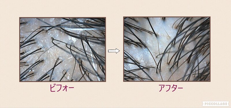 [アイキャッチ]～毛密・MOUMITU～頭皮の初期設定