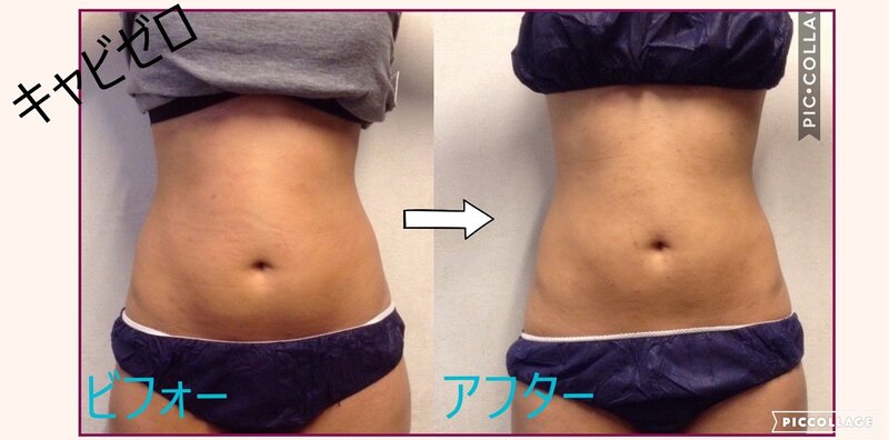 [アイキャッチ]短期間型ダイエットにも効果絶大！痩身マシーン”cavi ZERO”