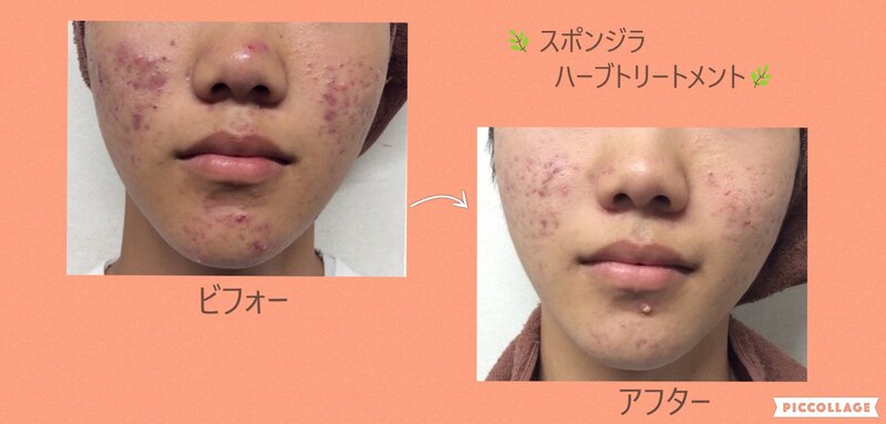 [アイキャッチ]《スポンジラ・ハーブトリートメント》 マスク荒れ・ニキビ・ニキビ跡・たるみ・シワ・シミ・くすみ・小顔等に効果的！