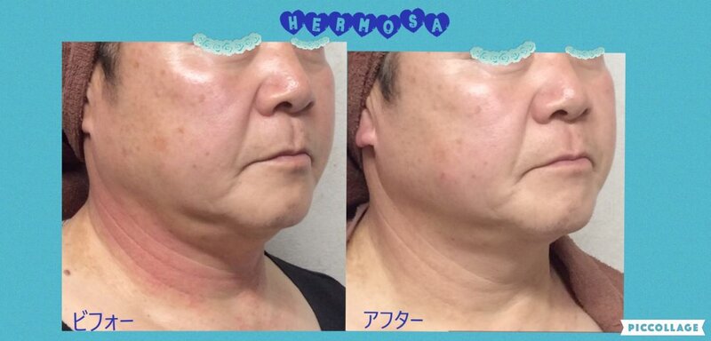 [アイキャッチ]最速で効果を極める♢エルモサ・ハーブクレストリバースケア♢