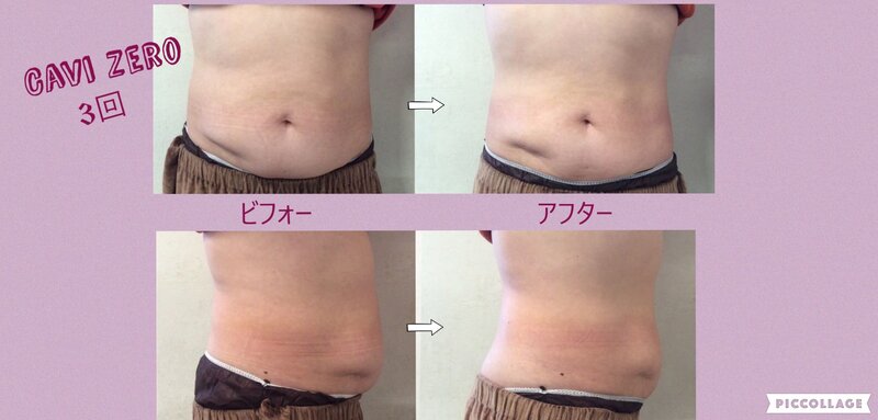 [アイキャッチ]★お正月太り解消!!痩身キャンペーン実施中★3回でポッコリお腹撃退!!ウエスト－5センチに成功✨