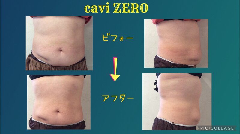 [アイキャッチ]短時間で圧倒的な効果！！痩身マシーンcavi ZERO（キャビゼロ）