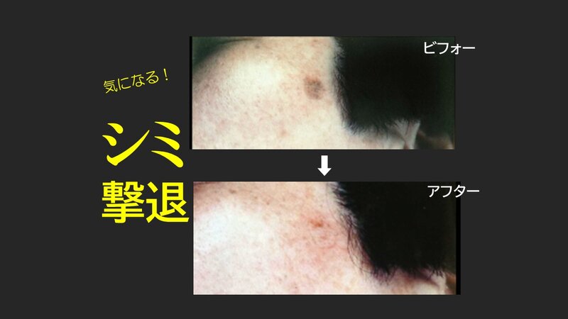 [アイキャッチ]シミ撃退!!イボ・ホクロも一気に取れちゃう!!大好評!!✨半額キャンペーン✨