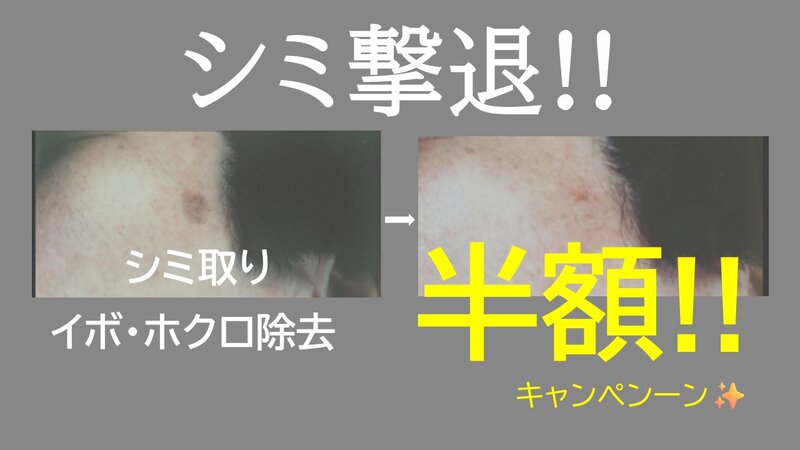 [アイキャッチ]シミとり＆イボ・ホクロ除去☆半額キャンペーン☆実施中!!