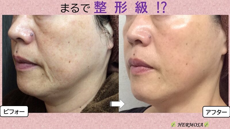 [アイキャッチ]まるで整形級の変化！！エルモサハーブトリートメント ✨