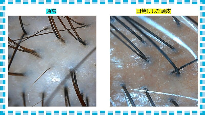 [アイキャッチ]頭皮・髪も日焼けしています！！