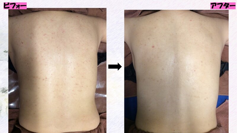 [アイキャッチ]背中ニキビ、諦めていませんか？