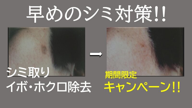 [アイキャッチ]【期間限定キャンペーン】 シミ・イボ・ホクロにお悩みの方必見！！