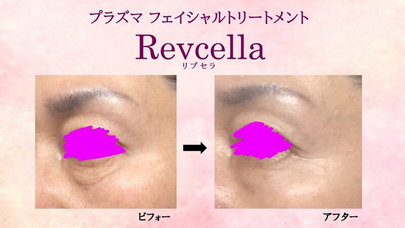 [アイキャッチ]プラズマシャワーでエイジングケア♡ ♦リブセラフェイシャルエステ♦