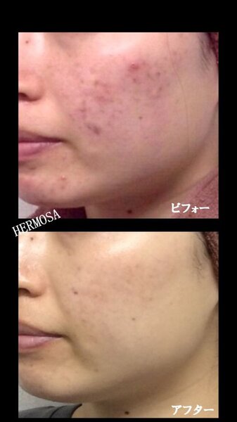 [アイキャッチ]トラブル肌もハーブで変わる!!