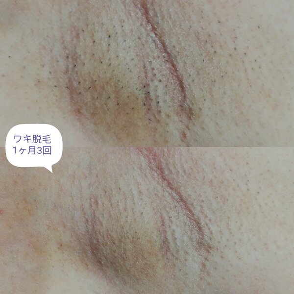 [アイキャッチ]短期間で綺麗に！RiとBiのたまごの脱毛機は速効脱毛！