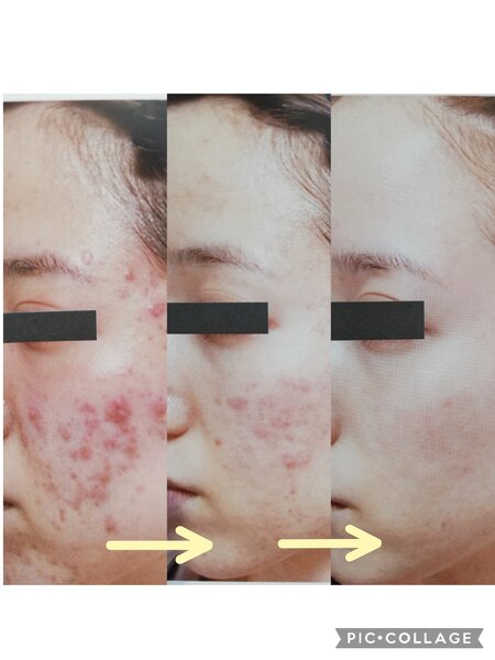 [アイキャッチ]お水から優しいRiとBiのたまごの顧問医師提携サロンで理想の肌へ