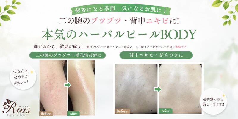 [アイキャッチ]🌿二の腕のプツプツ・背中ニキビに！本気のハーバルピールBODY✨