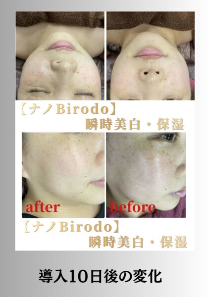 [アイキャッチ]新しいフェイシャルメニュー凄い過ぎ！これに尽きます！（VC+ヒアルロン酸篇）