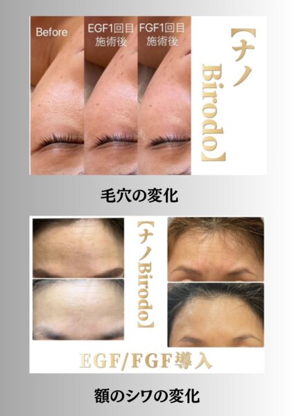 [アイキャッチ]新しいフェイシャルメニュー凄い過ぎ！これに尽きます！（EGF+FGF水光篇）