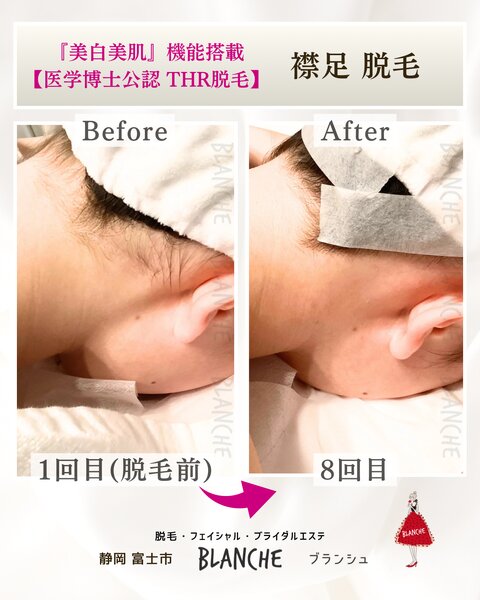 [アイキャッチ]祝成人！襟足脱毛のビフォーアフター【富士市ブランシュ】