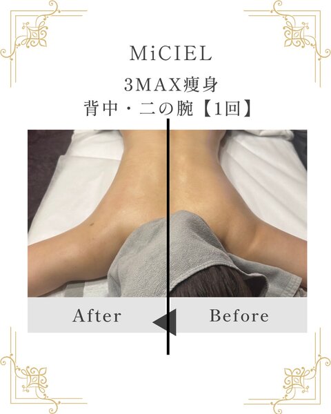 [アイキャッチ]3MAX痩身〜背中二の腕〜30代女性ビフォーアフター