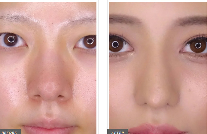 TCB東京中央美容外科 TCB式鼻翼縮小完全内側法 症例画像