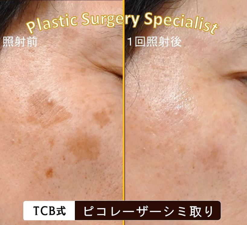 TCB東京中央美容外科 ピコレーザーシミ取り 症例画像