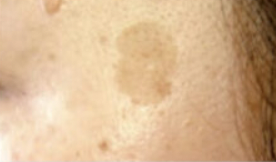 品川美容外科 日光性色素斑 症例画像