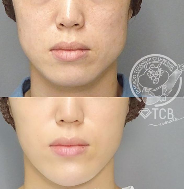 TCB東京中央美容外科 エラボトックス 症例画像