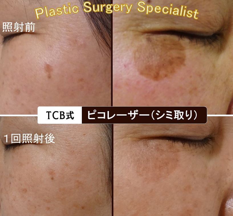 TCB東京中央美容外科 ピコレーザー（シミ取り） 症例画像
