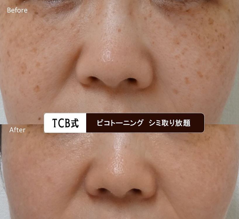 TCB東京中央美容外科 ピコトーニング シミ取り放題 症例画像